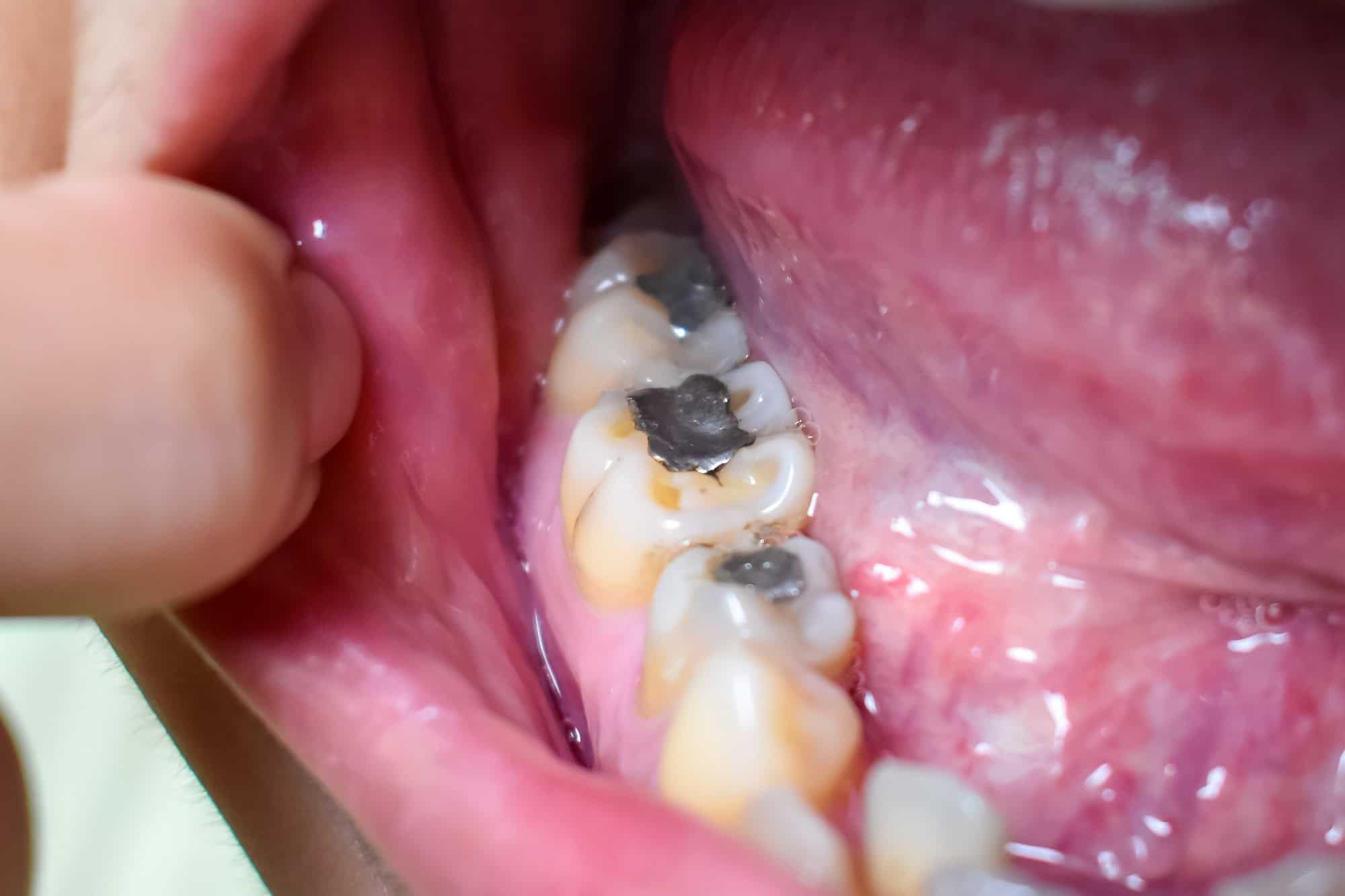 La Prohibición de Amalgamas Dentales con Mercurio en la UE: Implicaciones y Alternativas 12 amalgamas dentales