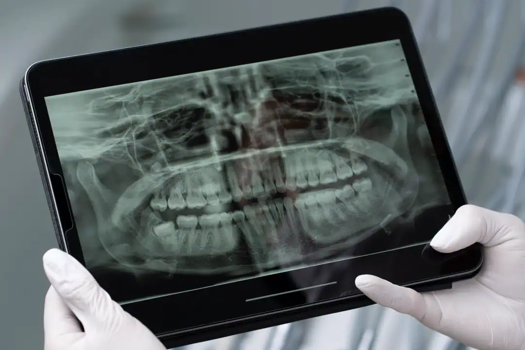 Guía Definitiva de Implantología 3D en Alicante: Innovaciones y Avances 2 implantología 3D