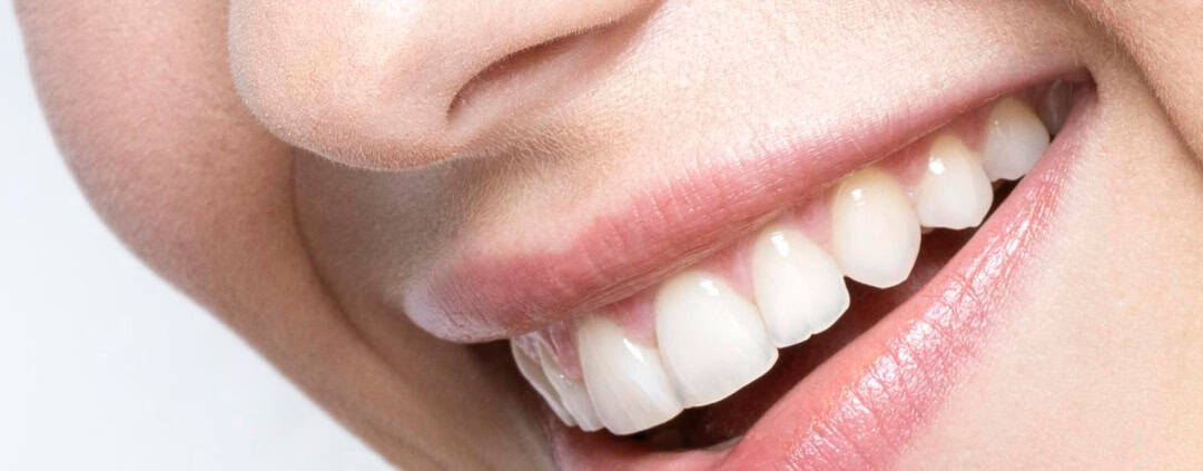 Primer plano de sonrisa tras blanqueamiento dental profesional en Clínica Dental Benalúa Alicante