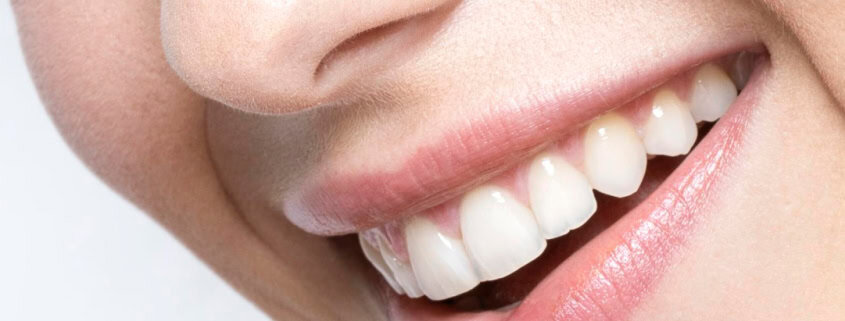 Primer plano de sonrisa tras blanqueamiento dental profesional en Clínica Dental Benalúa Alicante