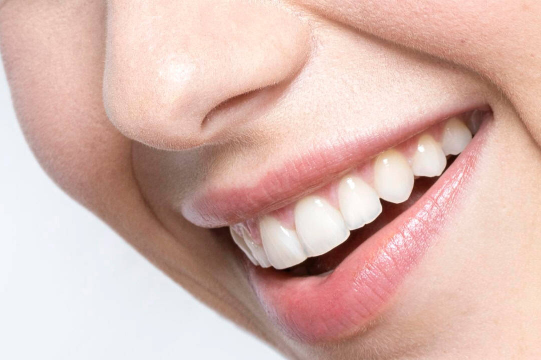 blanqueamiento dental profesional