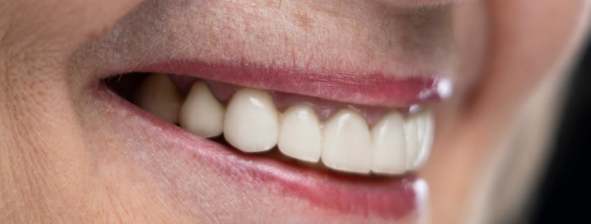 implantes dentales Blanqueamiento dental profesional: qué esperar y cuánto dura