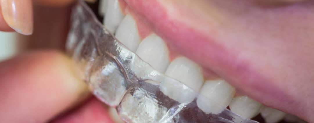 Ortodoncia invisible: ventajas, tiempos y mantenimiento 1 ortodoncia invisible-1 Blanqueamiento dental profesional: qué esperar y cuánto dura