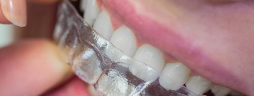 ortodoncia invisible-1 Blanqueamiento dental profesional: qué esperar y cuánto dura