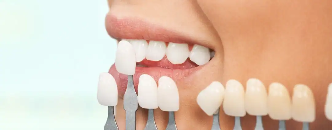 comparativa de carillas-1 Tartrectomía Dental: Guía Completa de Limpieza