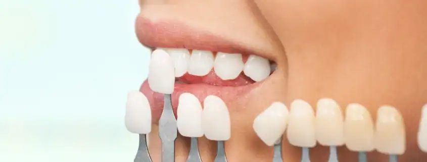 comparativa de carillas-1 Tartrectomía Dental: Guía Completa de Limpieza
