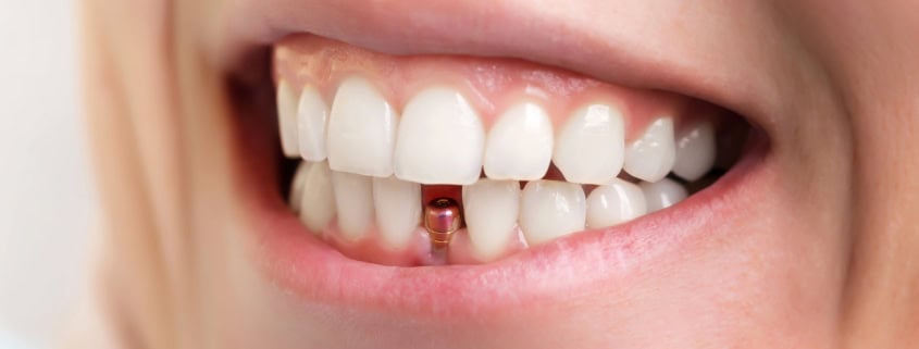 Implantes Dentales en Alicante: Recupera tu capacidad de comer, reír y vivir sin complejos 3 implante dental