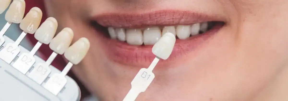 ¿Cómo Limpiar Dientes Amarillos? 1 Dentista comparando el color de los dientes de una paciente con una guía de tonos dental