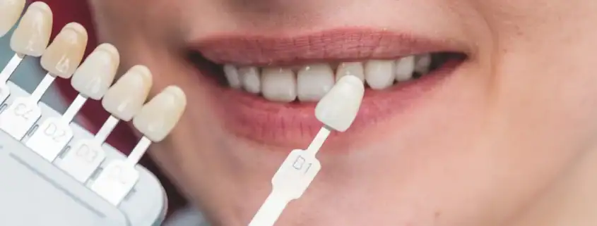 Dentista comparando el color de los dientes de una paciente con una guía de tonos dental