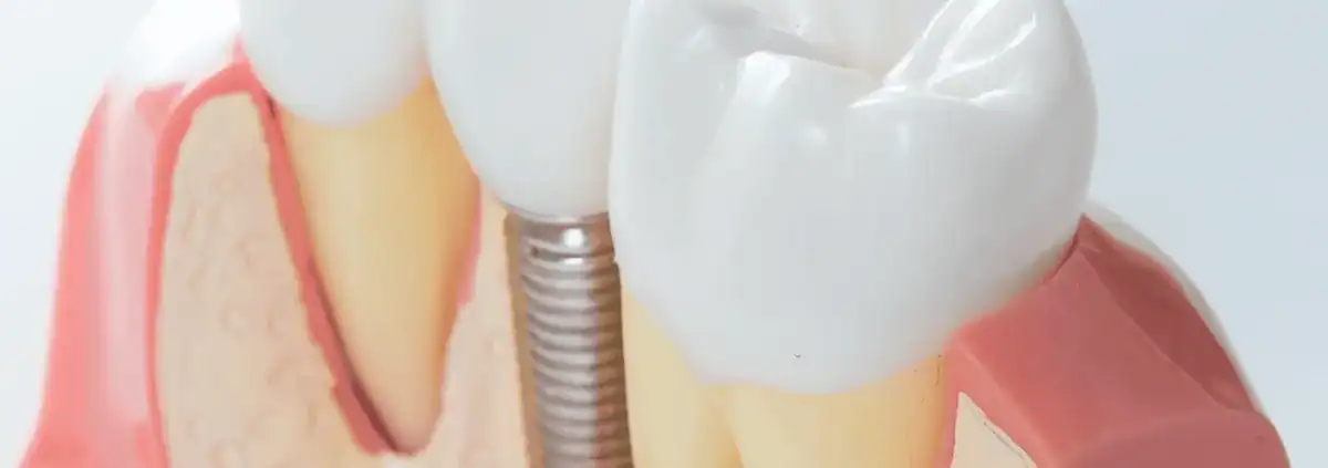 Implantología 3D: Revolucionando la Reposición Dental 1 Maqueta de implante dental con corona entre dientes naturales - implantología 3D