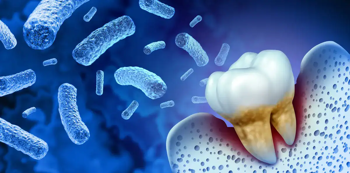 Ilustración de bacterias alrededor de un diente con la encía y el hueso afectados por periodontitis