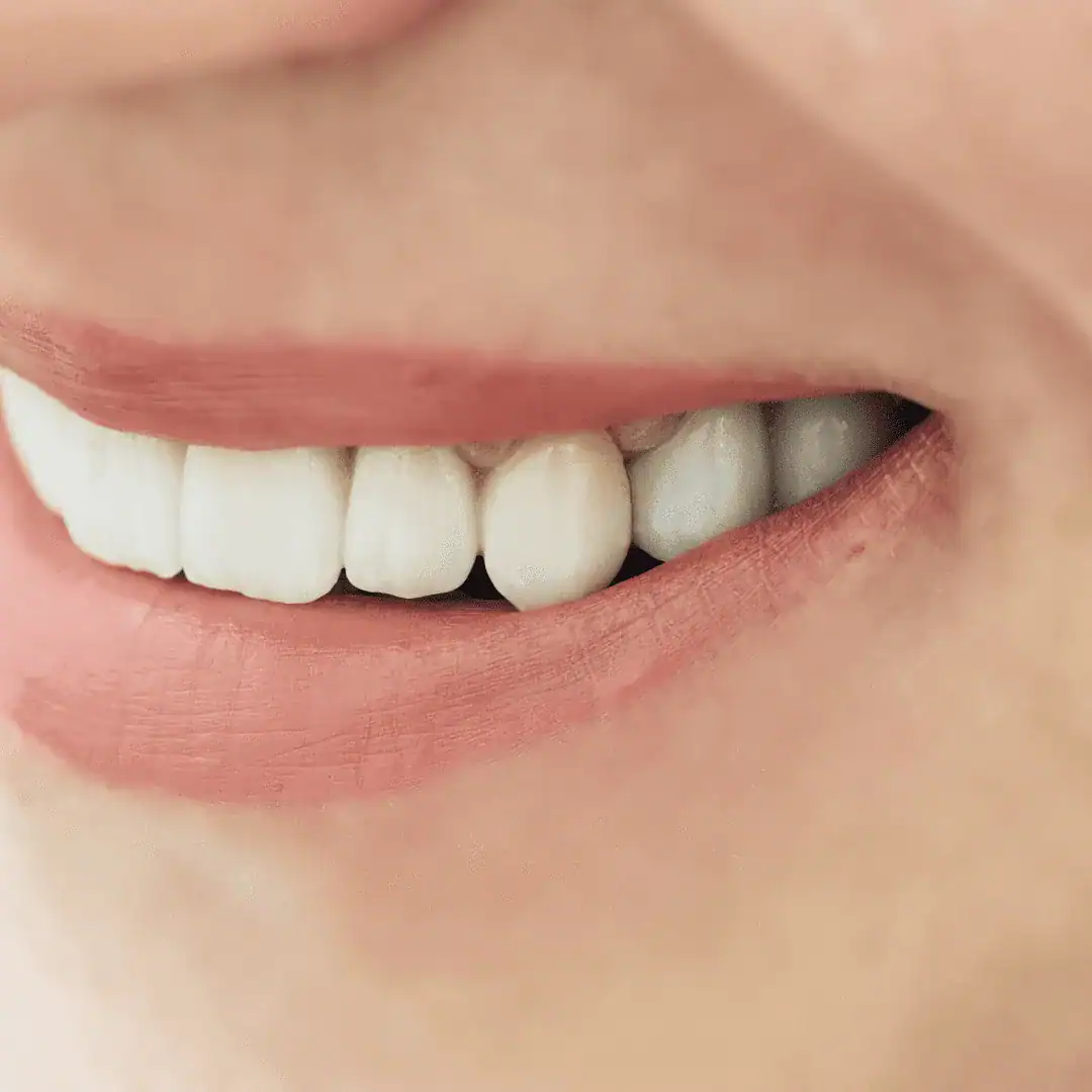 sonrisa con corona de zirconio - coronas de zirconio